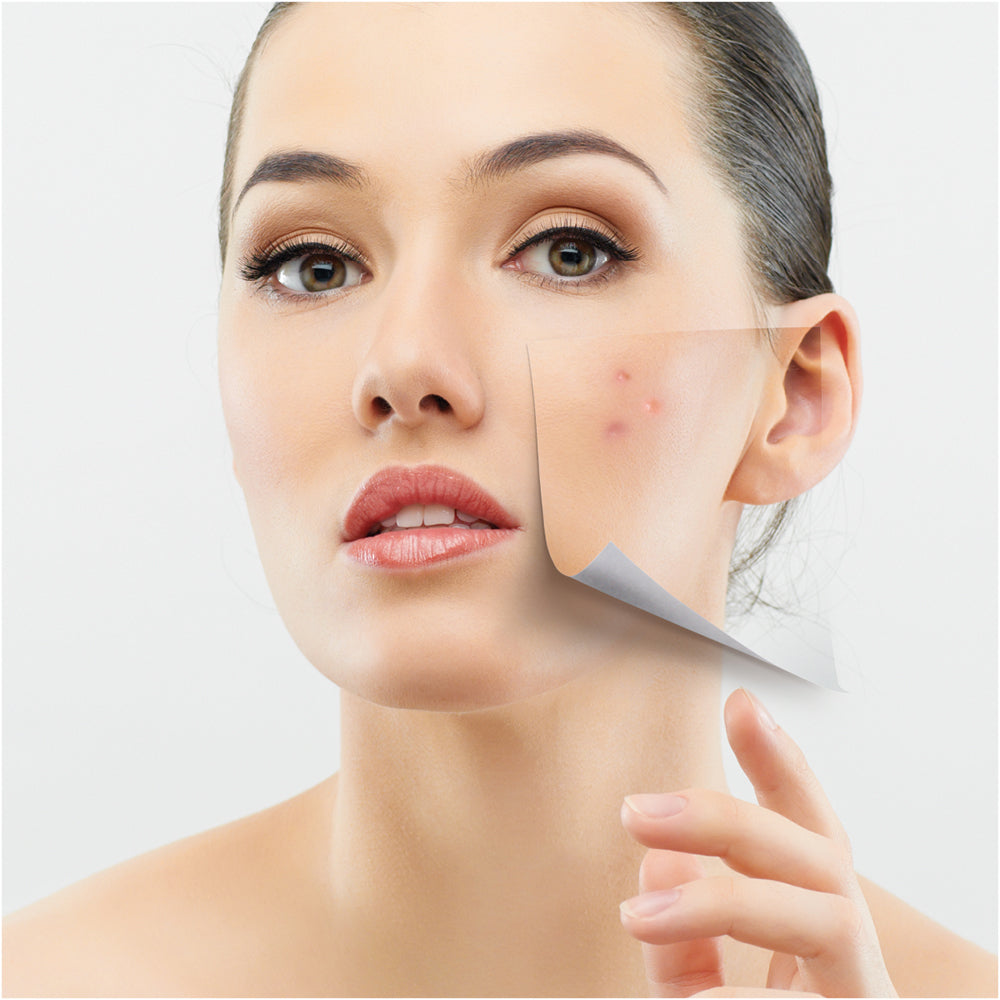 What Are the Causes and Fixes for Acne?